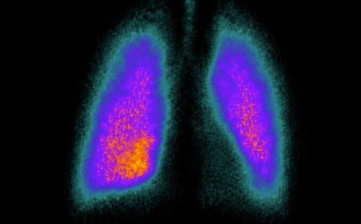 Más allá del inhalador, vea adónde llega realmente el fármaco.